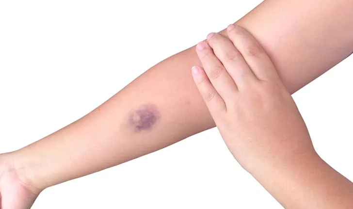 9 signs of serious disease from bruises on the body
